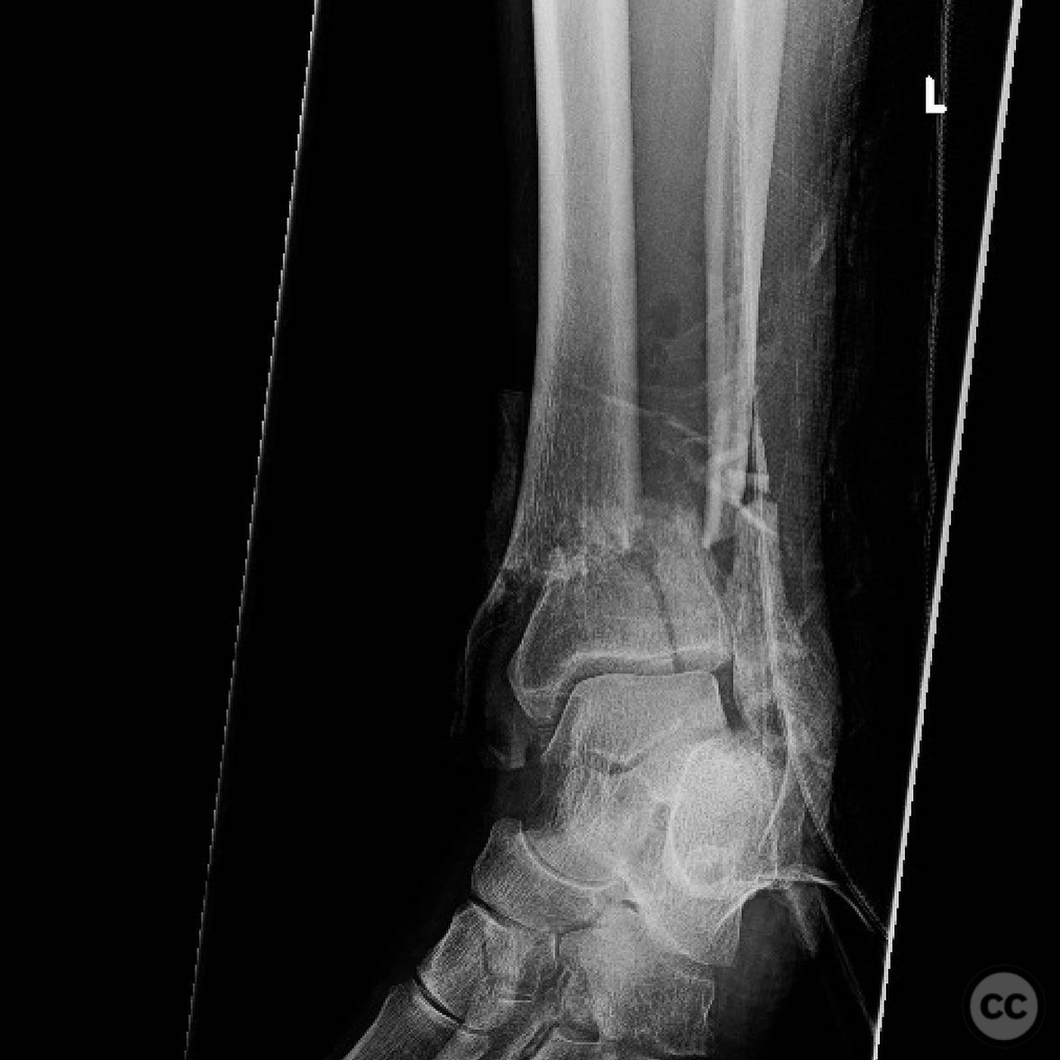 Open Pilon Pilon Nonunion Repair with Deformity Correction