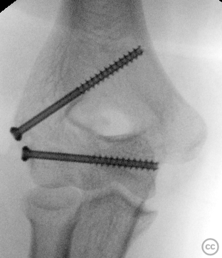 case image
