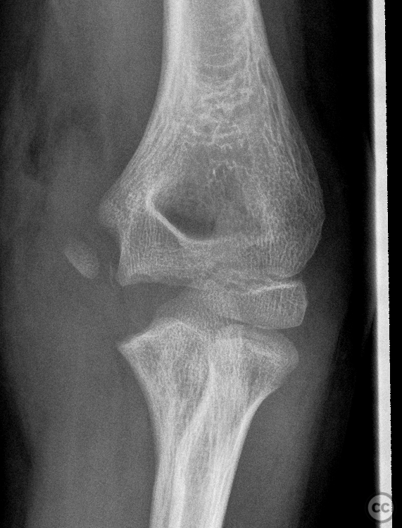 dislocation of right elbow with medial epicondyle fracture icd 10