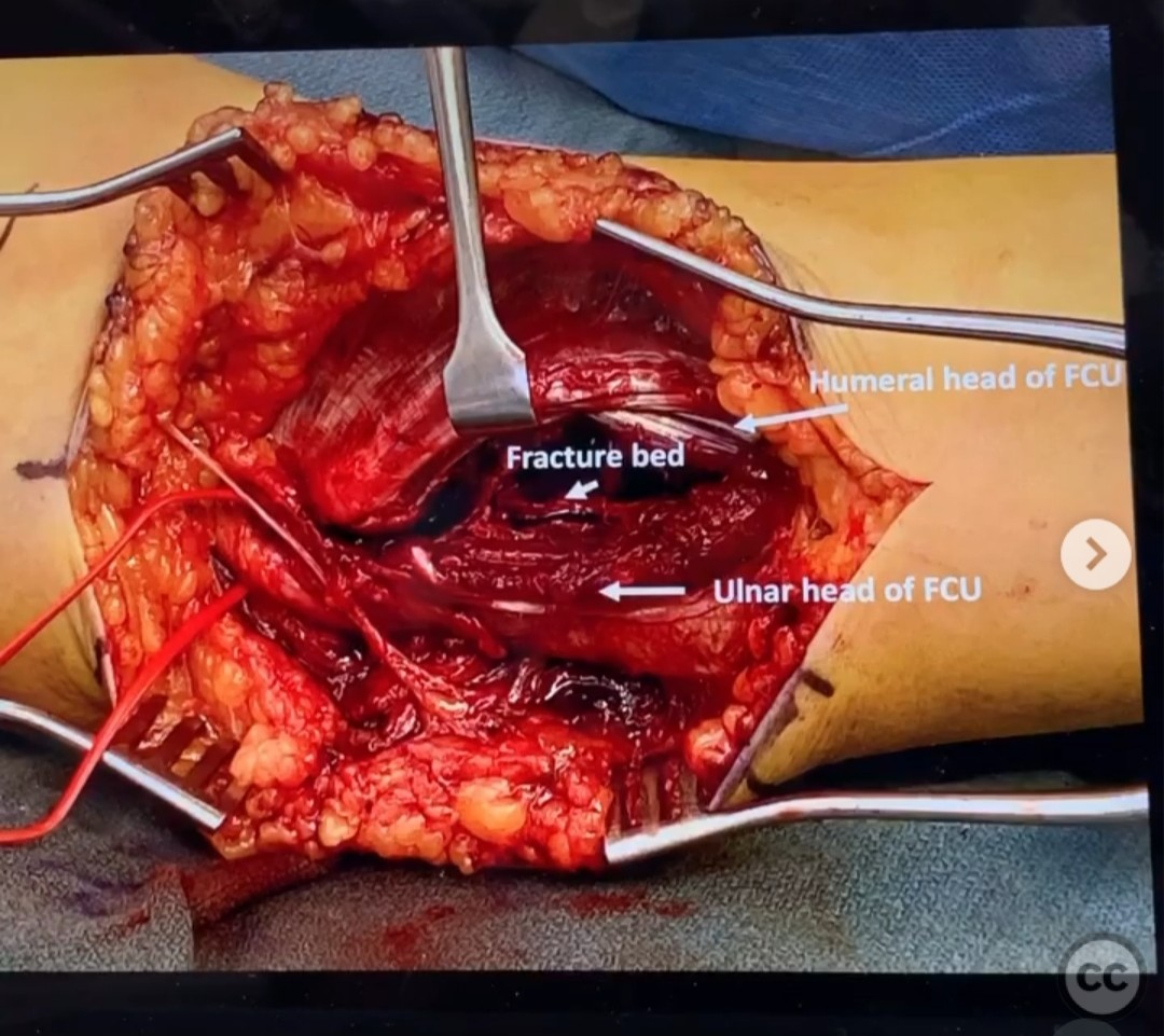 case image