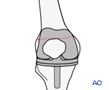 Knee - UCPF V