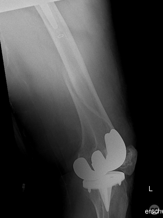Rorabeck II Vancouver C inter-implant periprosthetic femur fracture