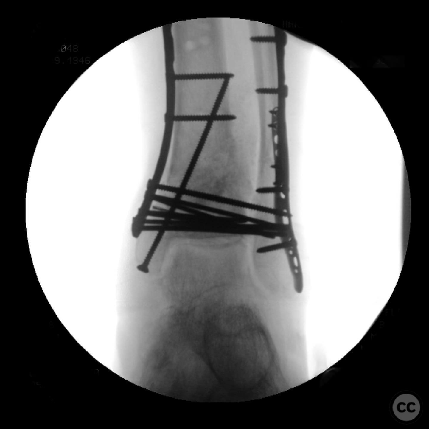 Open Pilon Pilon Nonunion Repair with Deformity Correction