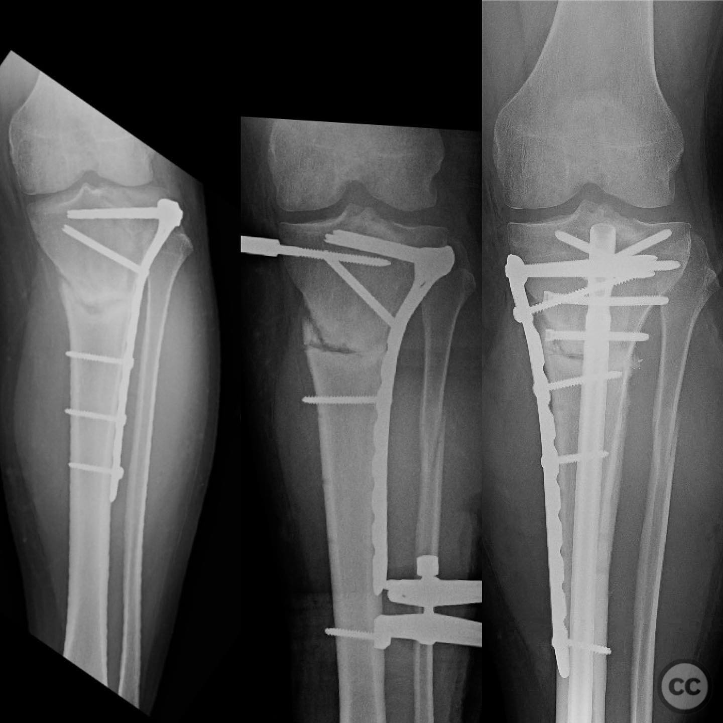 Proximal Tibia Nonunion with Varus Deformity Correction and Stabilization