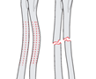Radius Ulna - PCCF 2x-EMD