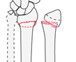 Metaphyseal - AO/OTA 2R3Ax