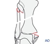 Proximal - AO/OTA 4F1x