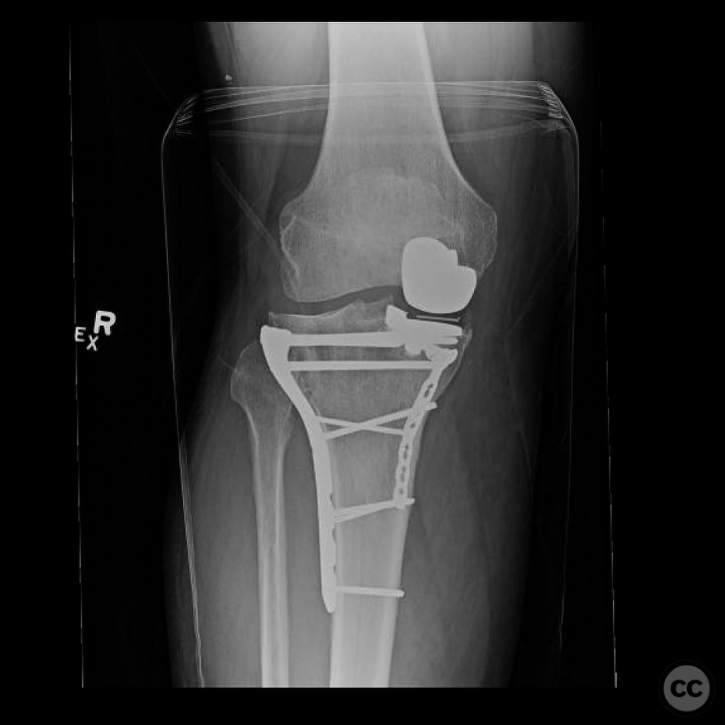 Periprosthetic Bicondylar Tibial Plateau Fracture around a Medial ...