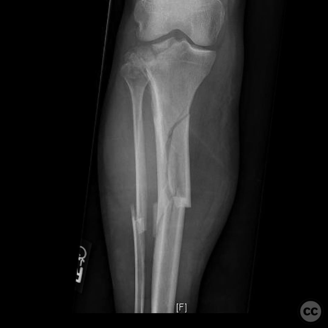 case image