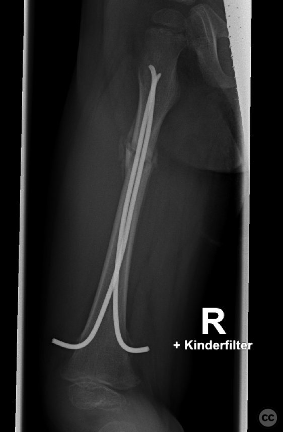 Pediatric Femoral Shaft Fracture Managed with Elastic Stable ...