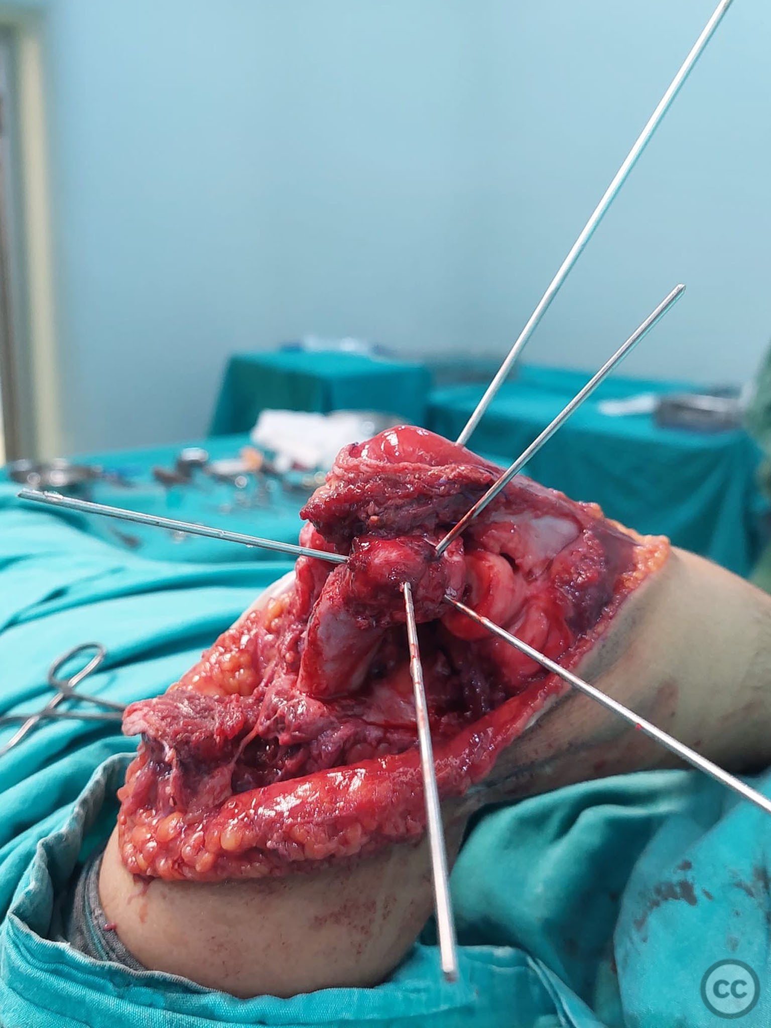 case image