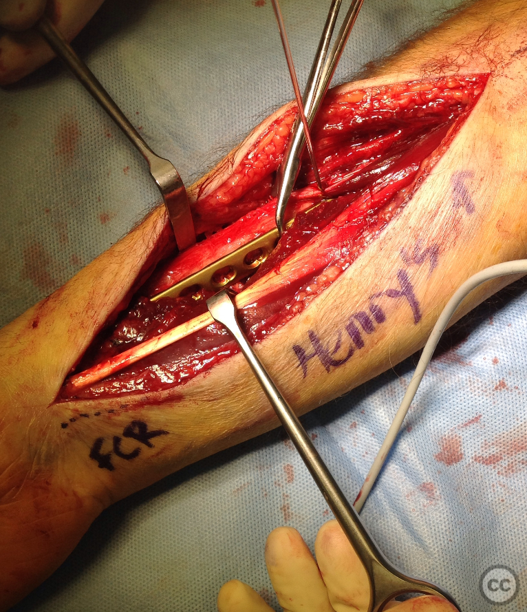 case image