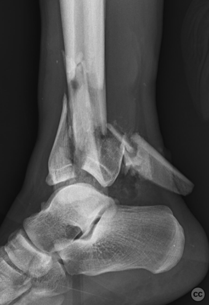 case image