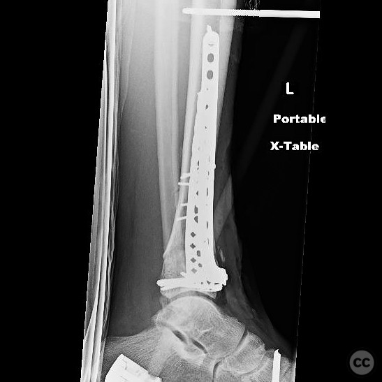 AO/OTA 43-C Type Pilon Fracture with Compartment Syndrome Management