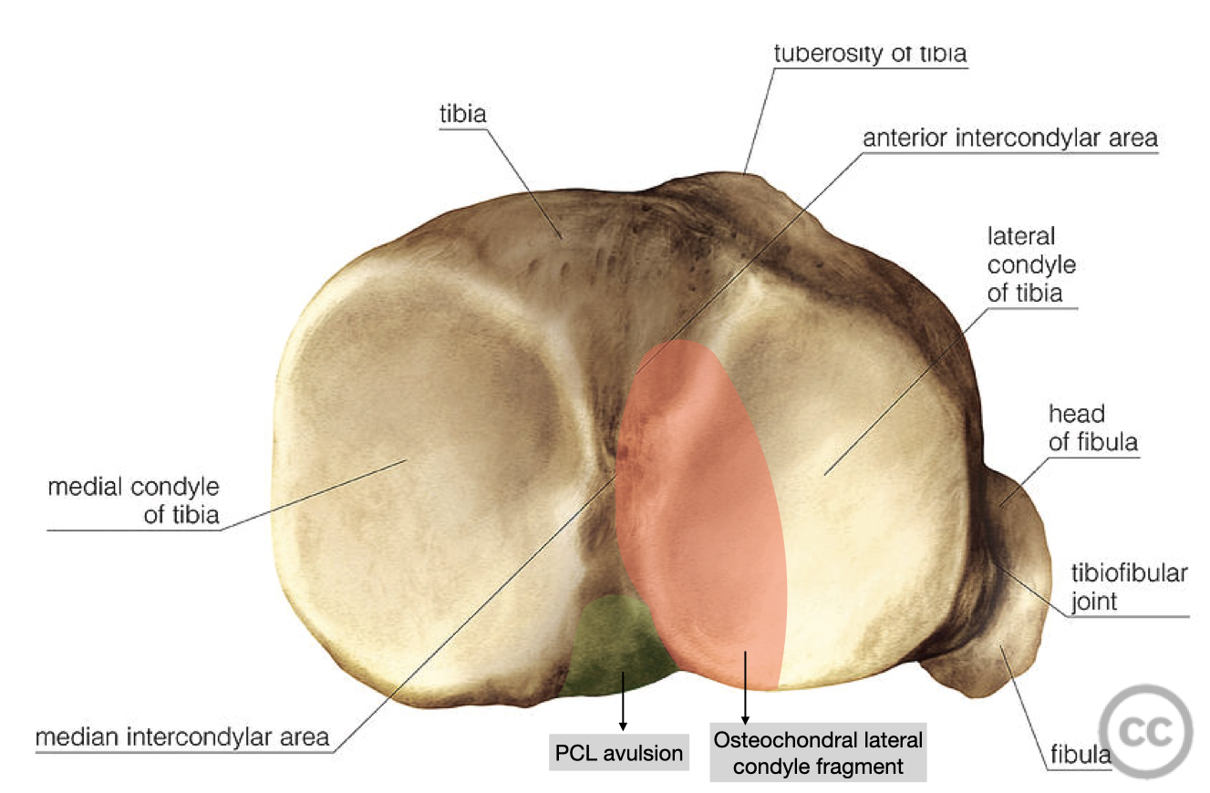 Ipsilateral lateral condyle Hoffa's fracture with PCL avulsion fracture ...