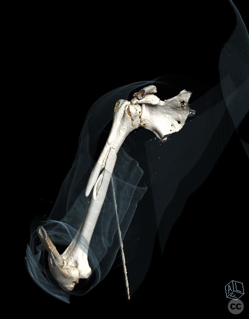 Spiral Humeral Shaft Fracture