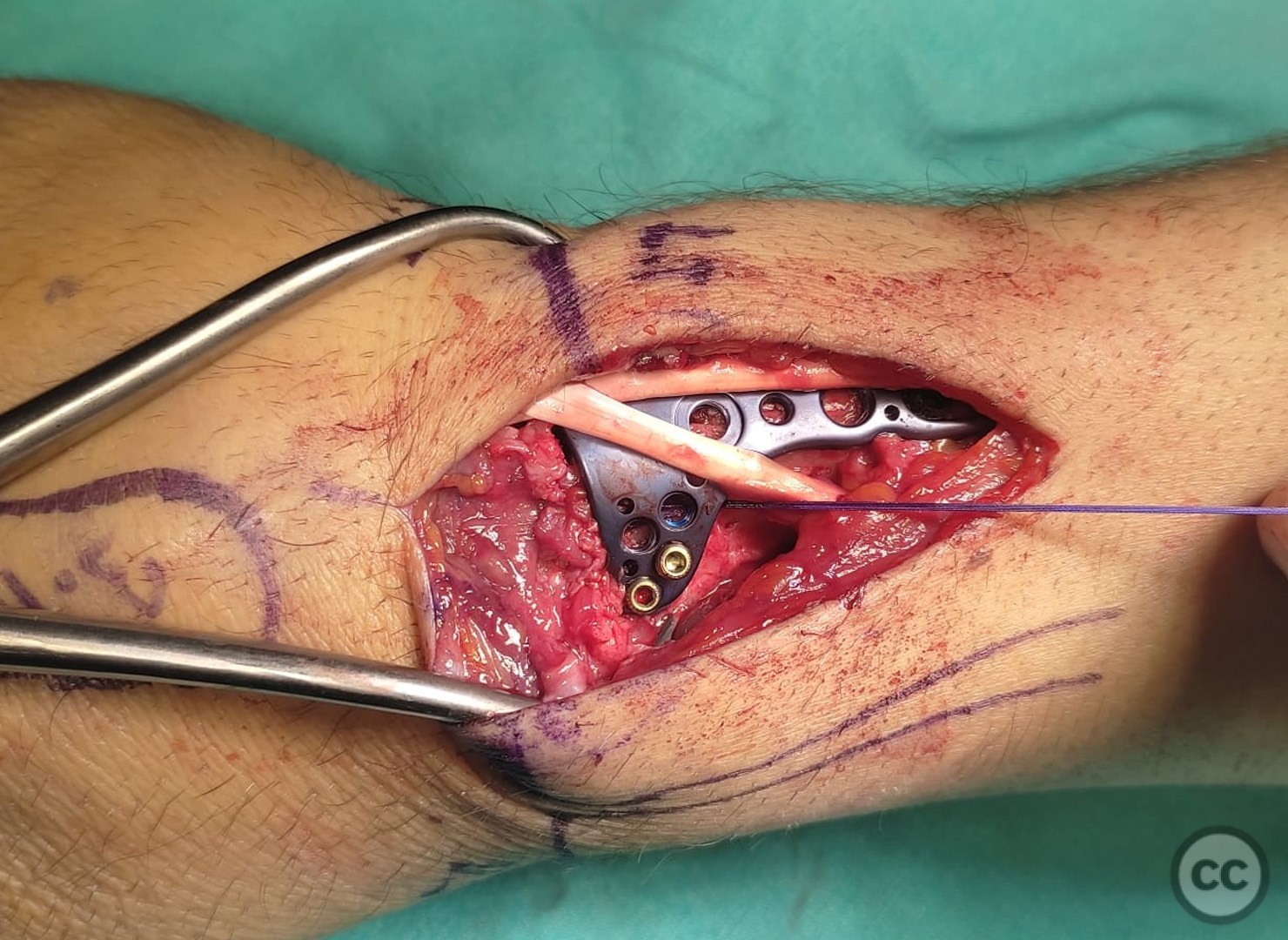 case image