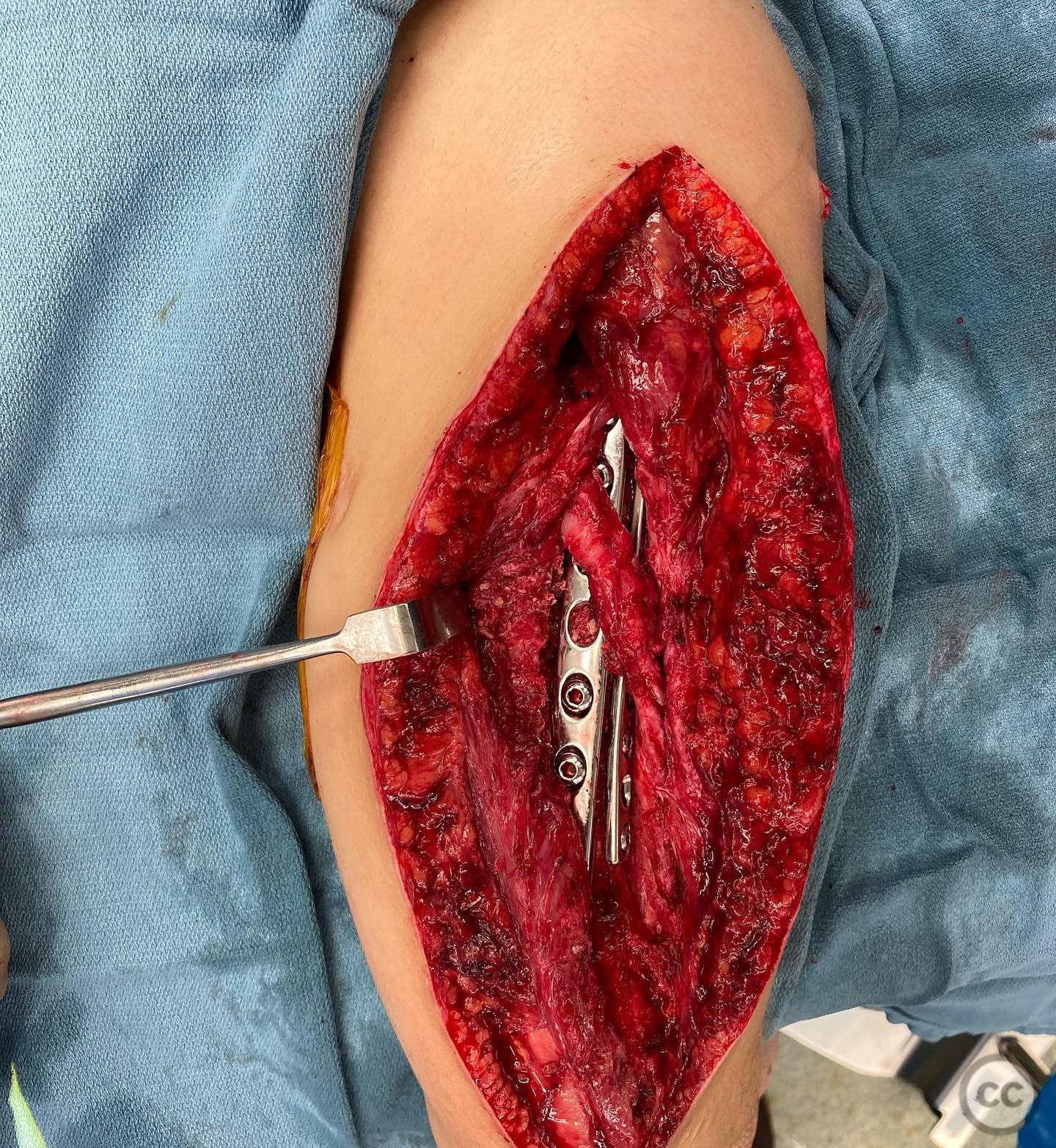 case image