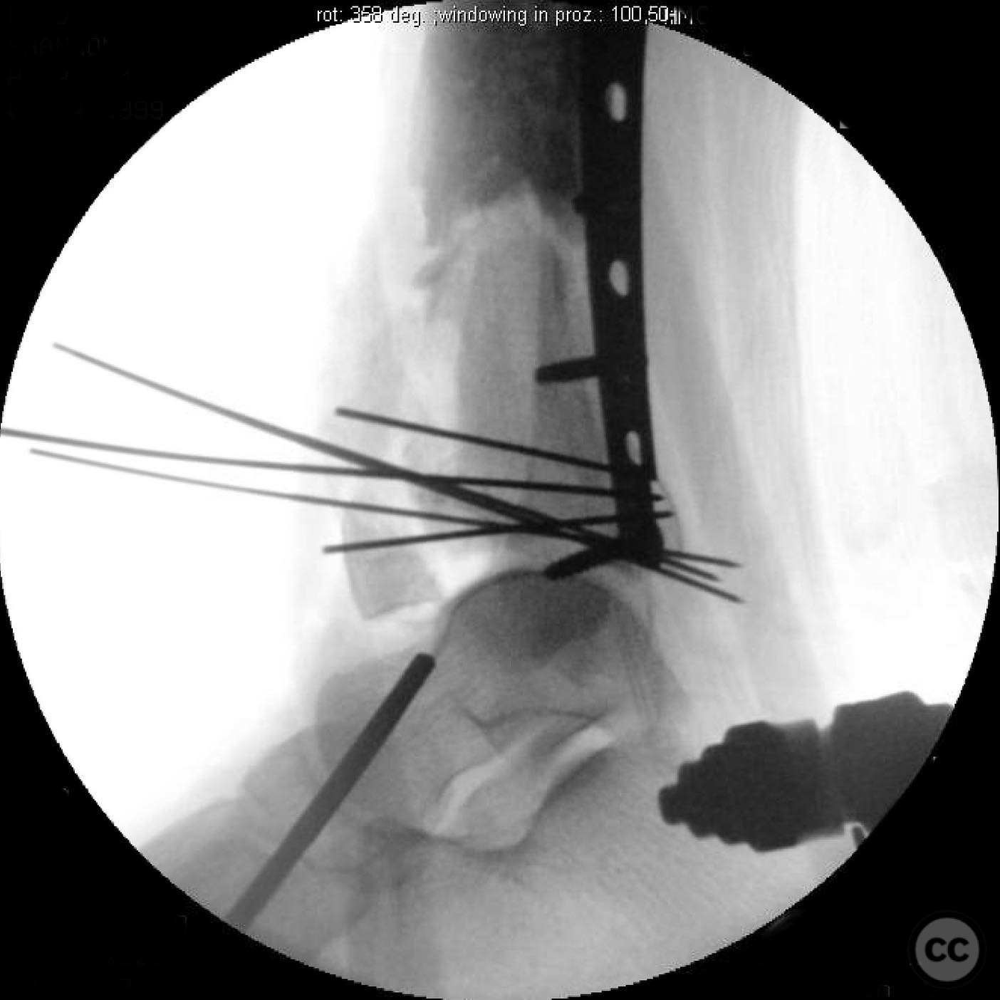 Complex Pilon Fracture with Segmental Bone Loss and Syndesmotic Disruption