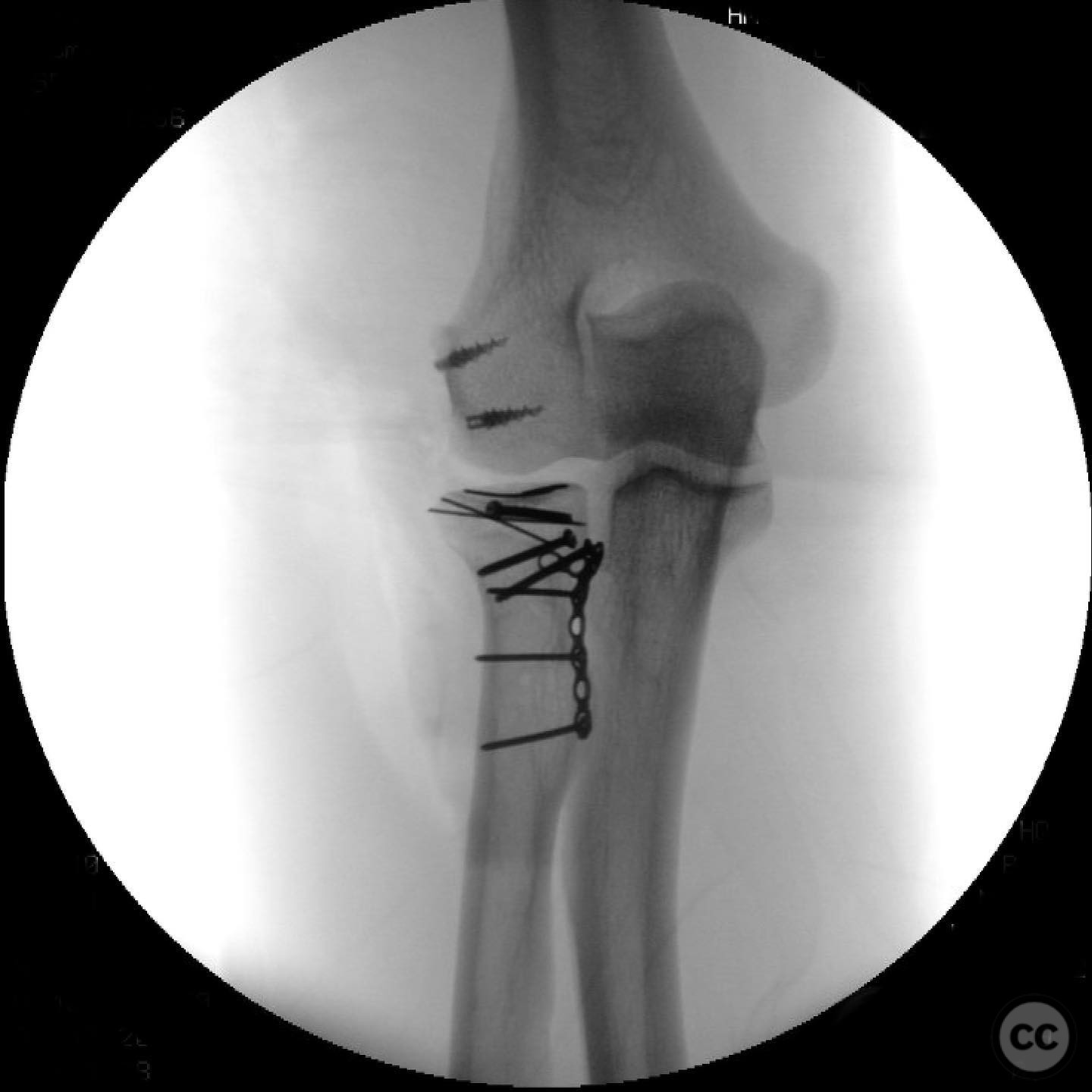 Complex Essex-Lopresti Variant: Comminuted Radial Head Fracture Managed ...