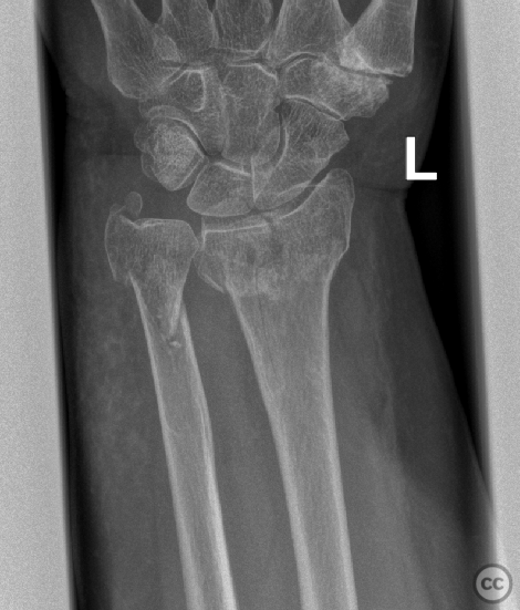 C3 distal radius fracture with distal ulna metaphyseal fracture