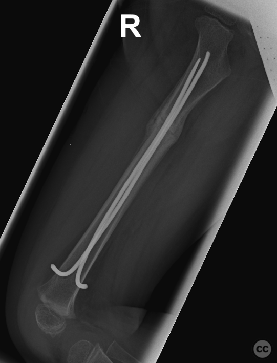 Pediatric Femoral Shaft Fracture Managed with Elastic Stable ...