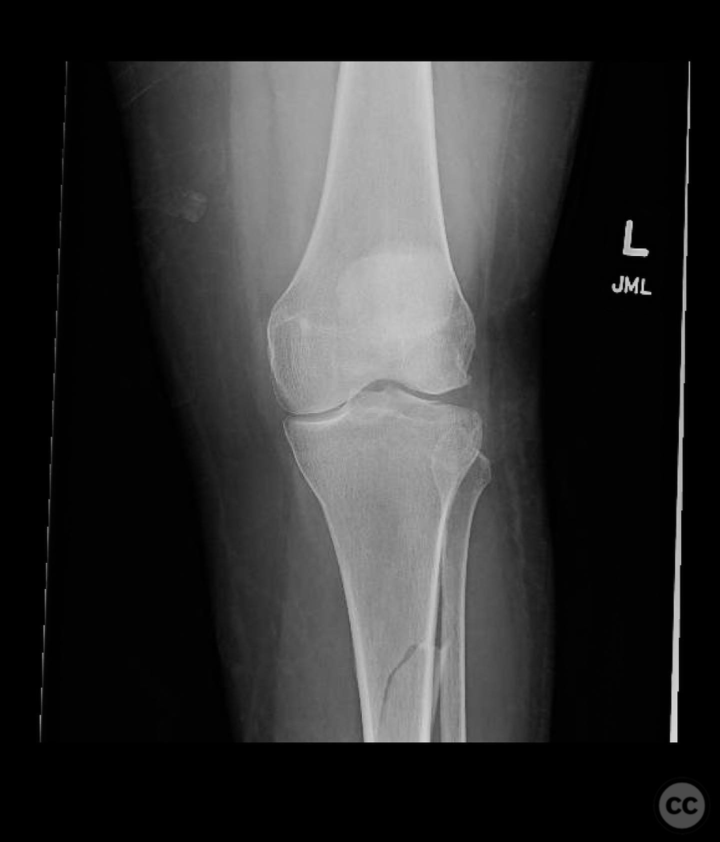 AO/OTA 41-B3 Lateral Tibial Plateau Fracture with Ipsilateral Tibial ...