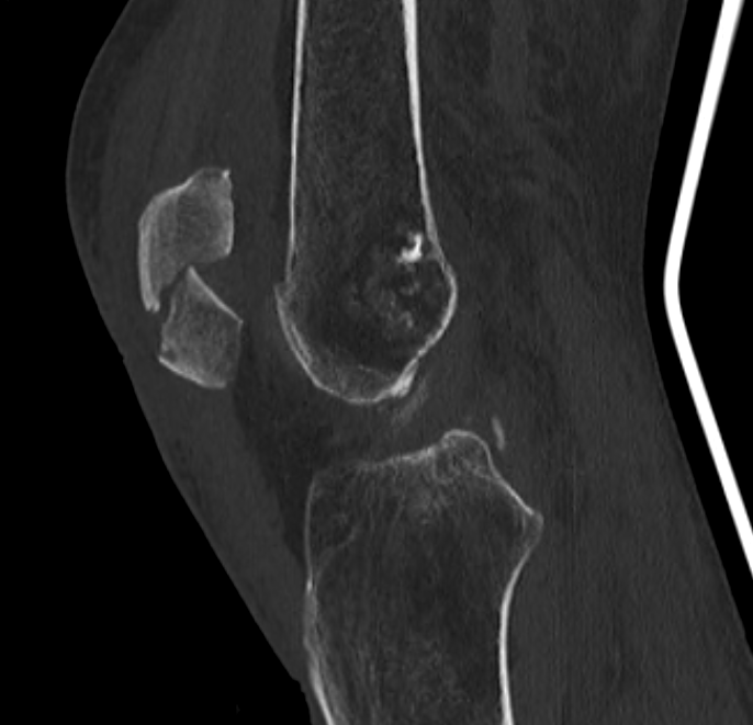 Comminuted patella fracture with retinacular preservation