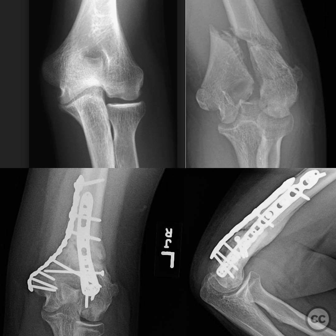 Supracondylar Intercondylar Distal Humerus Fracture with Fishtail ...