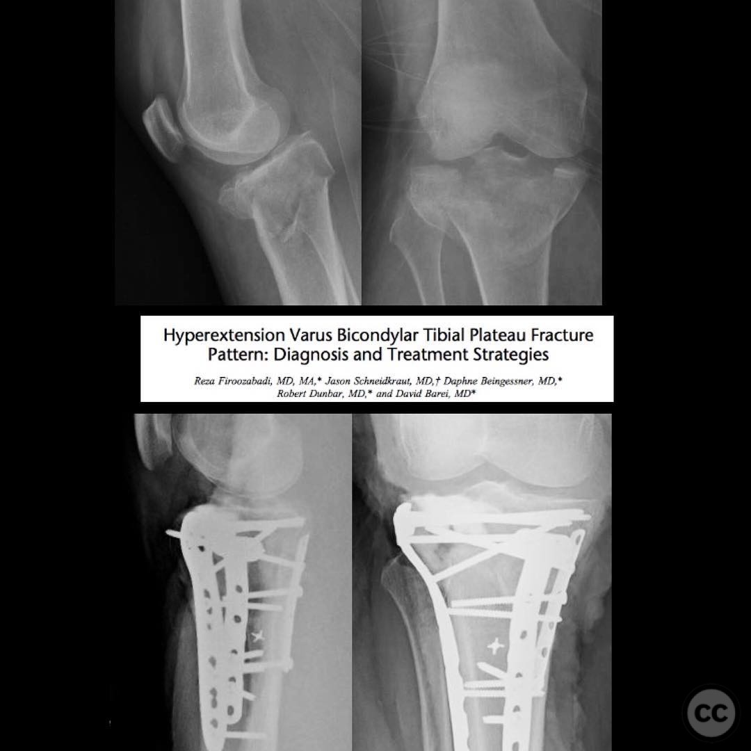 Hyperextension Varus Bicondylar Tibial Plateau Fracture with Posterior ...