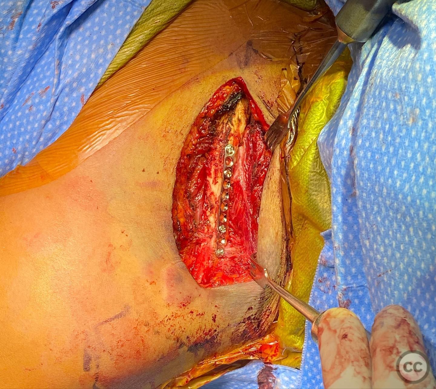 case image