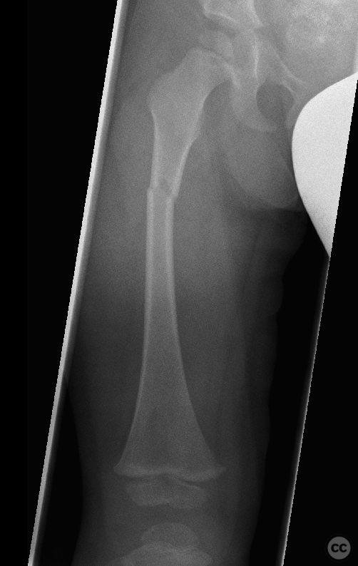 Pediatric Femoral Shaft Fracture Managed with Elastic Stable ...
