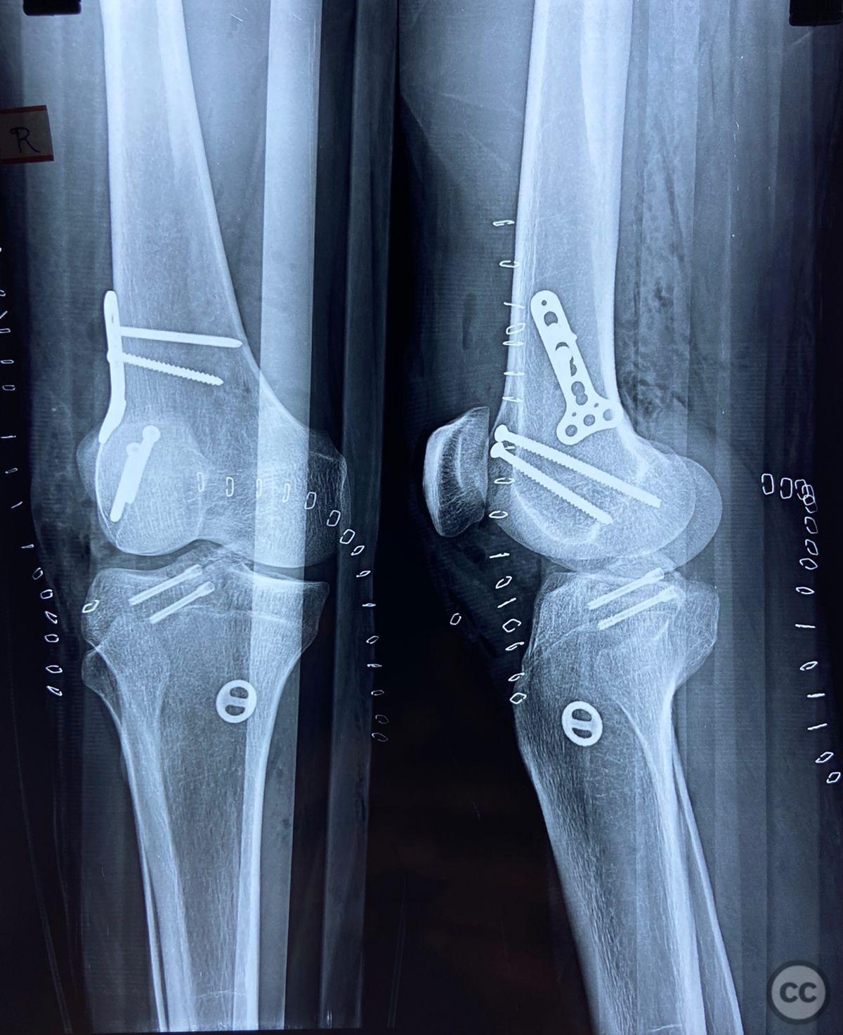 Ipsilateral Lateral Condyle Hoffa S Fracture With PCL Avulsion Fracture And Lateral Tibial