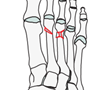 Metatarsal -AO/OTA 87x