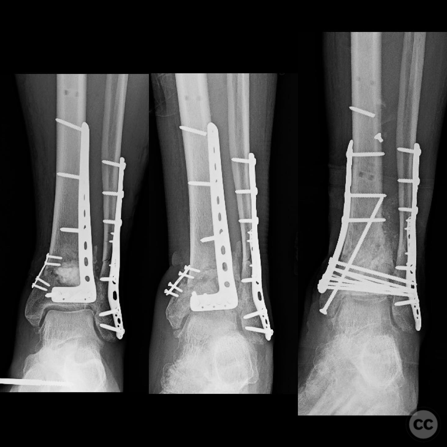 Open Pilon Pilon Nonunion Repair with Deformity Correction