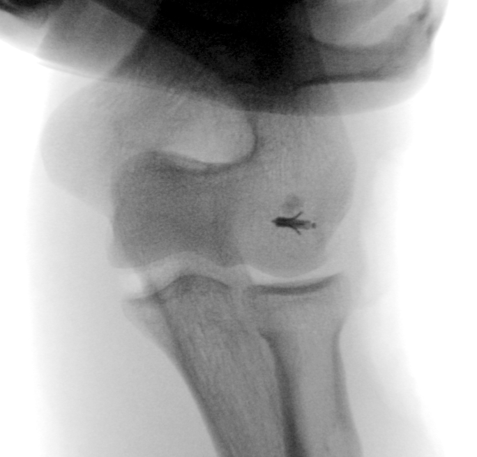 Multidirectional instability following posteromedial elbow dislocation