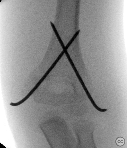 case image
