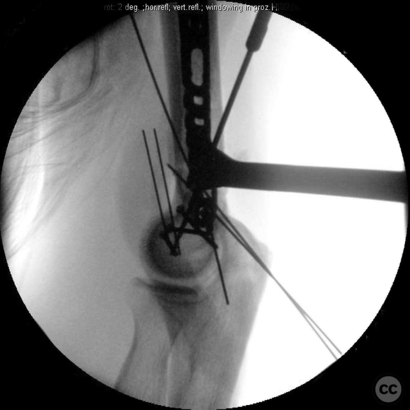 Comminuted Capitellum Fracture with Lateral Epicondyle Involvement in a ...