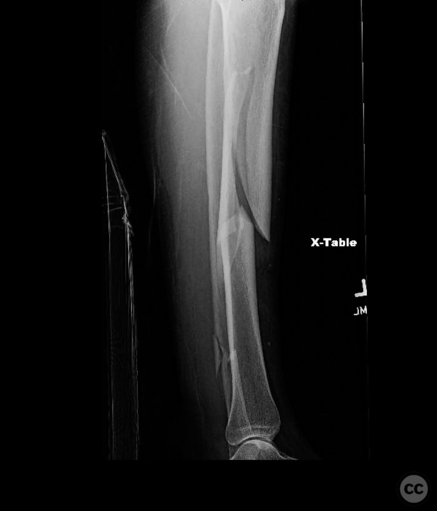 Ipsilateral Tibia AO/OTA 41-B3 Lateral Tibial Plateau Fracture with Ipsilateral Tibial ...