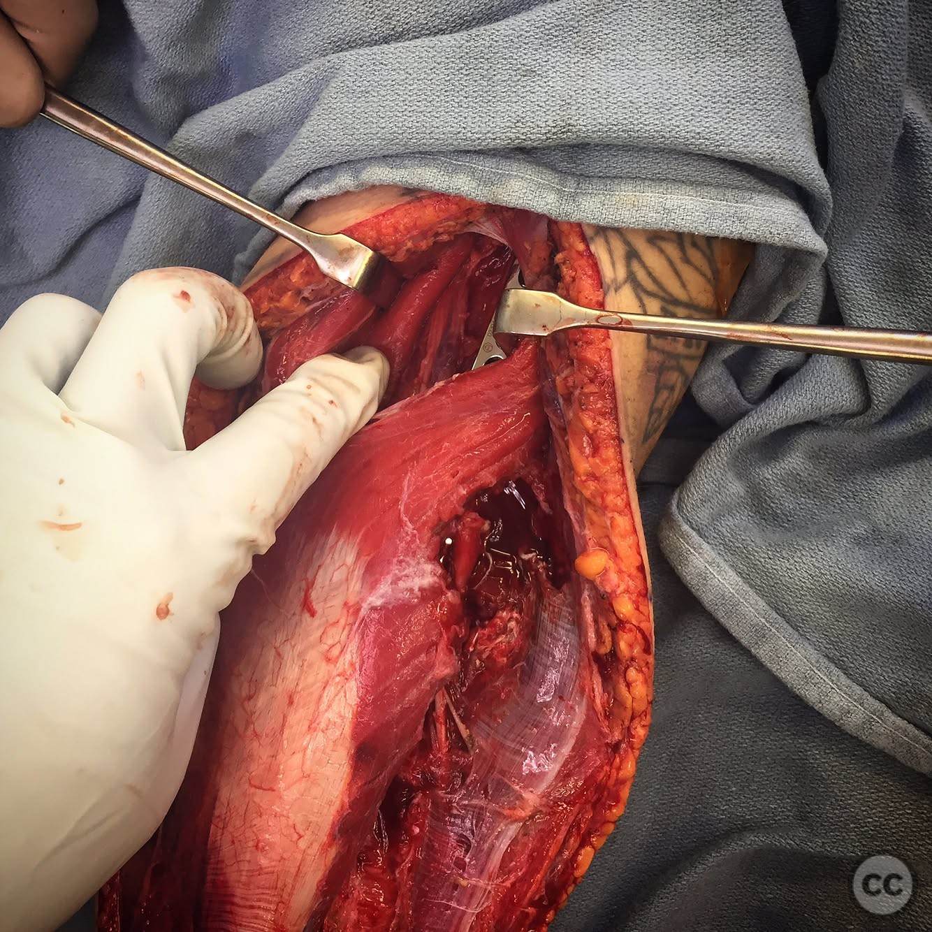 case image