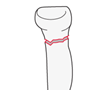 Proximal - AO/OTA 2R1x