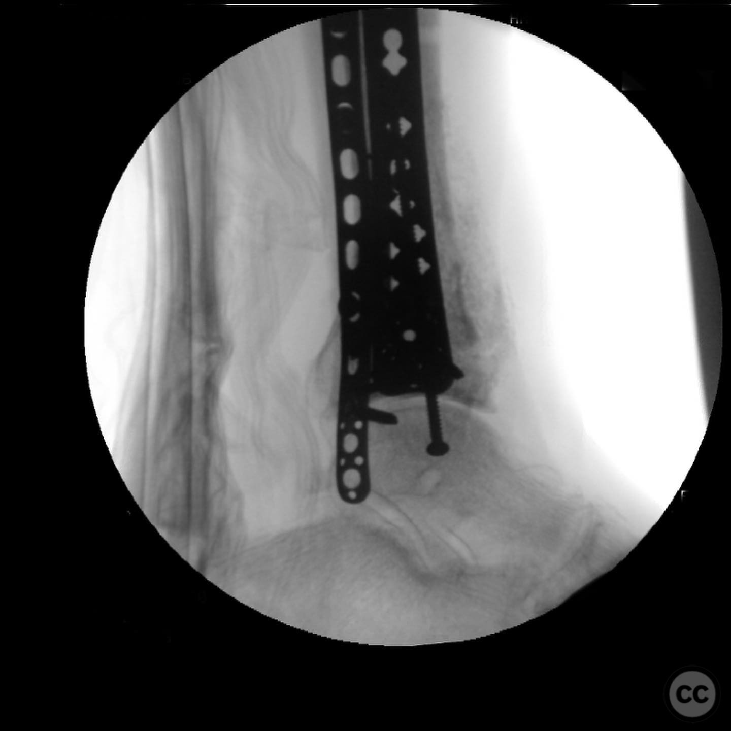 Open Pilon Pilon Nonunion Repair with Deformity Correction