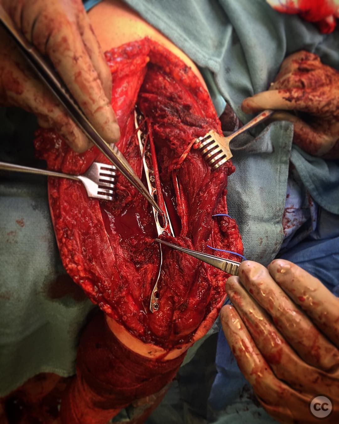 case image