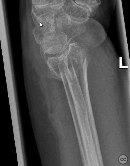 C3 distal radius fracture with distal ulna metaphyseal fracture