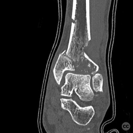 case image