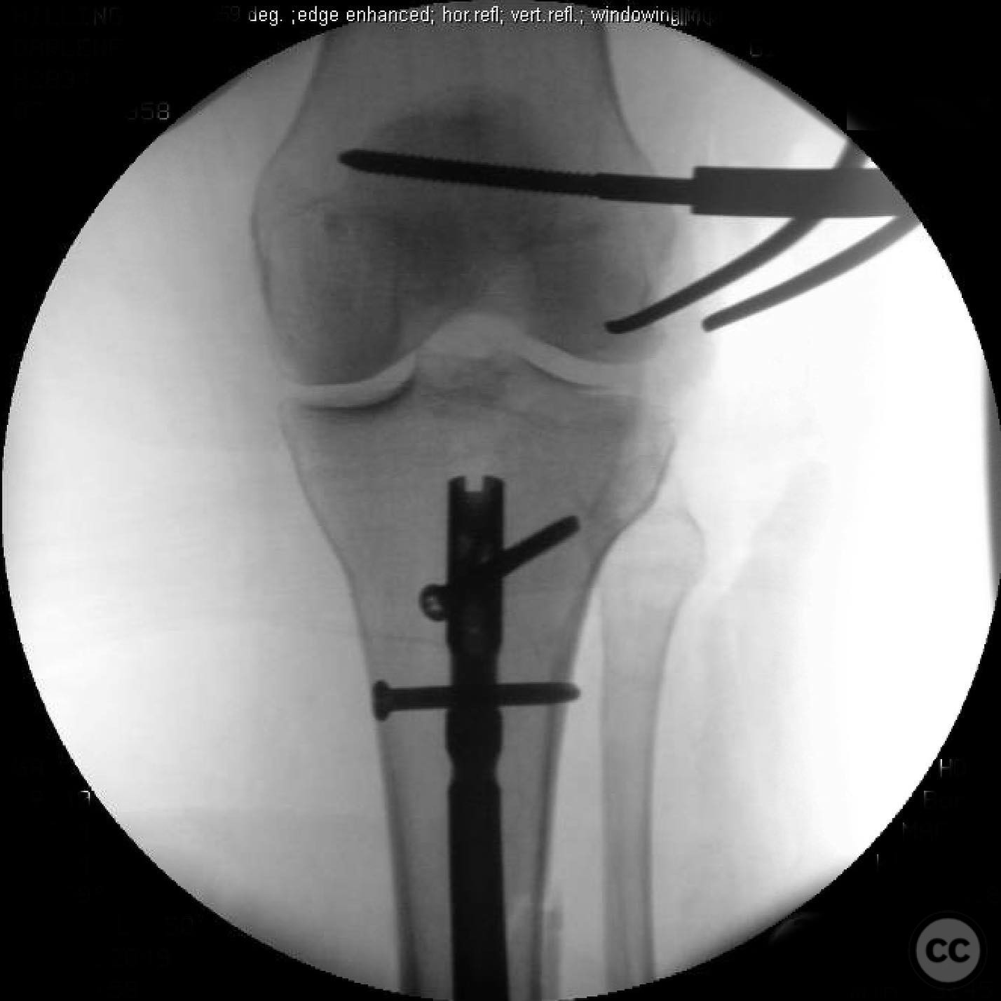 Ipsilateral Tibia AO/OTA 41-B3 Lateral Tibial Plateau Fracture with Ipsilateral Tibial ...