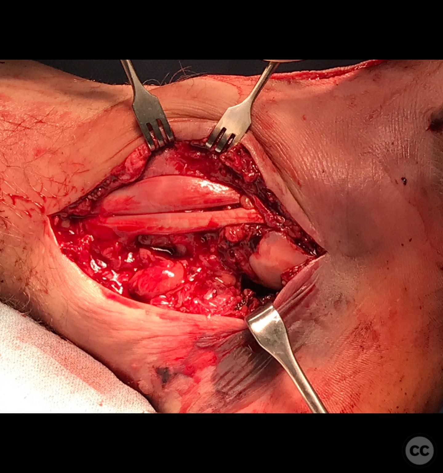 case image