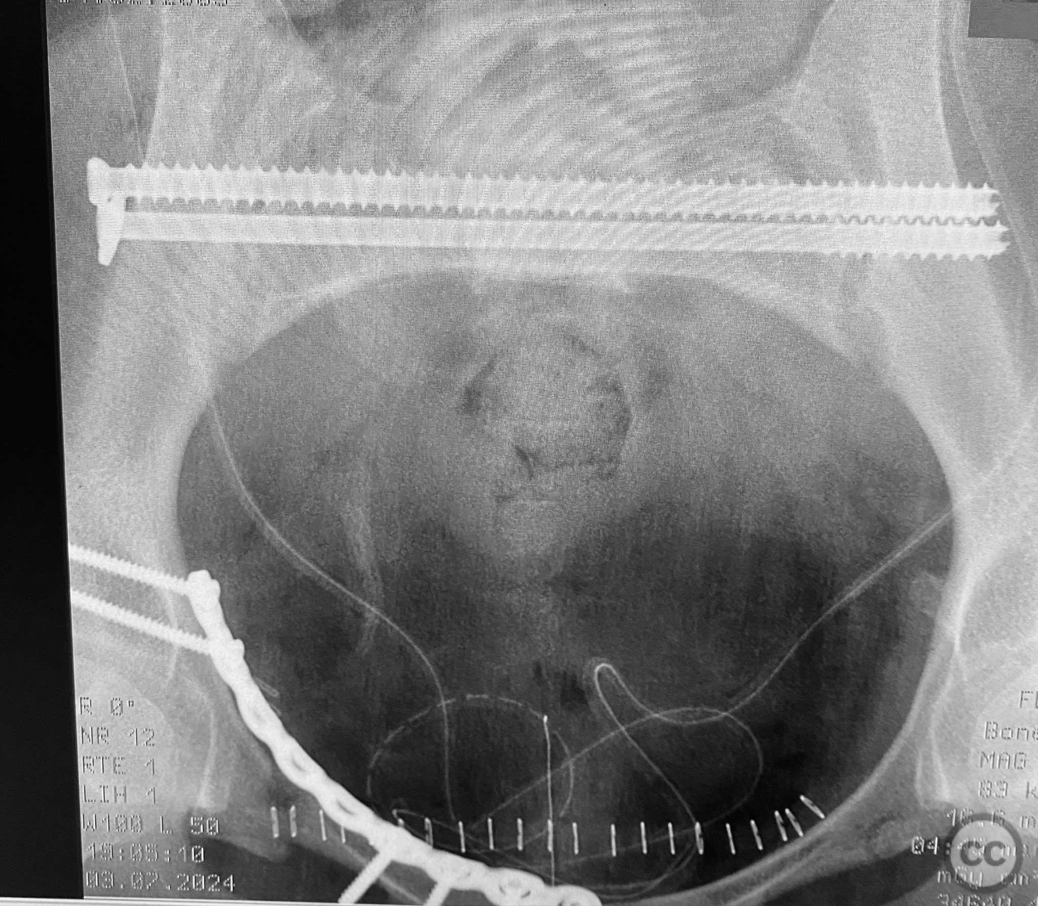 Complex Pelvic Ring Disruption with Bilateral SI, Bilateral Ramus, and ...