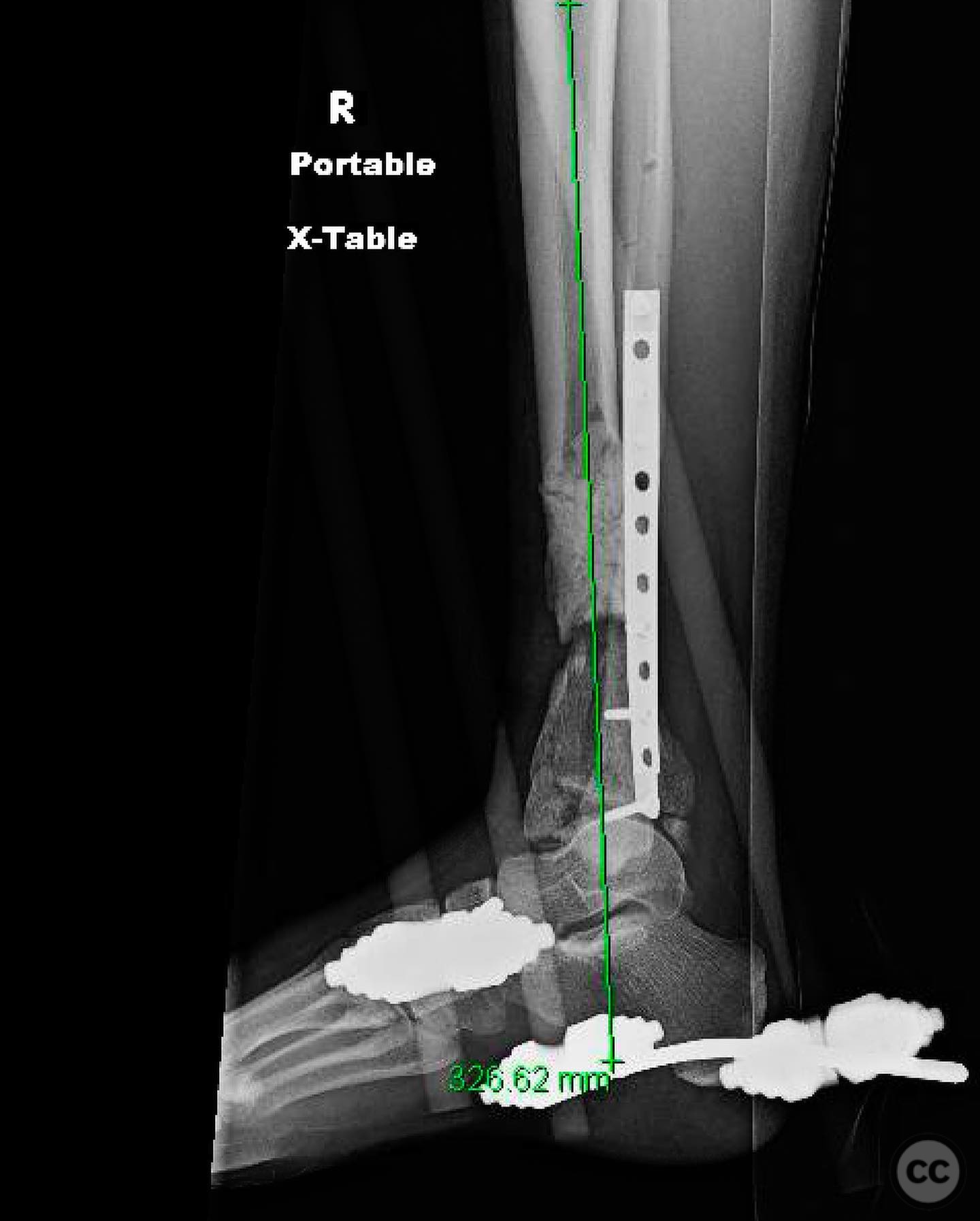 Complex Pilon Fracture with Segmental Bone Loss and Syndesmotic Disruption