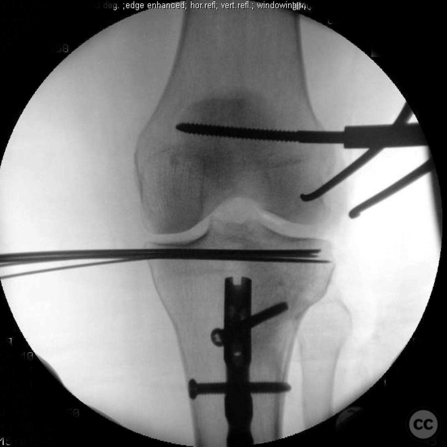 Ipsilateral Tibia AO/OTA 41-B3 Lateral Tibial Plateau Fracture with Ipsilateral Tibial ...